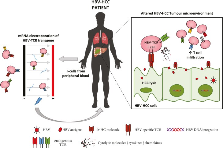 HBV-HCC treatment with mRNA electroporated HBV-TCR T cells.