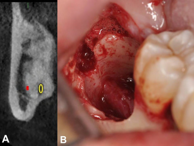 Trigeminal nerve injuries. Four years' experience at a single Argentine referral center and a literature review.