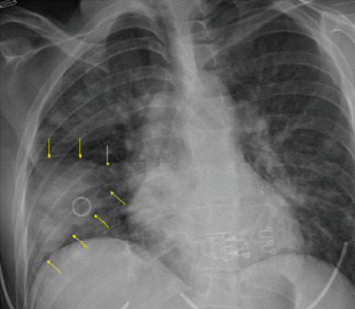 Hampton's Hump: A Notable Radiographic Finding in a Patient with Infectious Endocarditis.