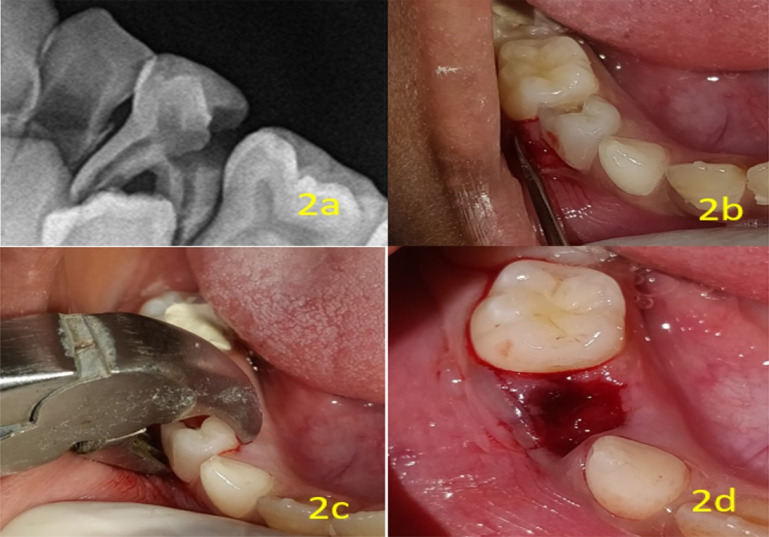 Comparative evaluation of efficacy of Physics Forceps versus conventional forceps in pediatric dental extractions: a prospective randomized study.