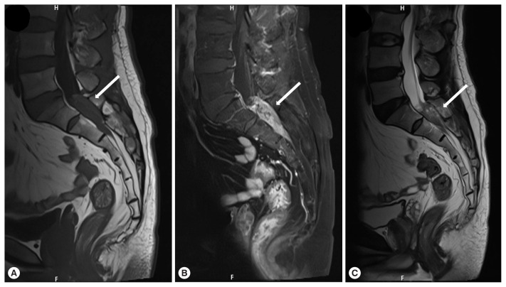 A Human Case of Lumbosacral Canal Sparganosis in China.