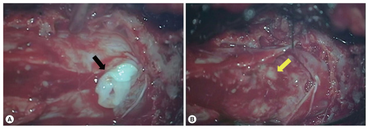 A Human Case of Lumbosacral Canal Sparganosis in China.