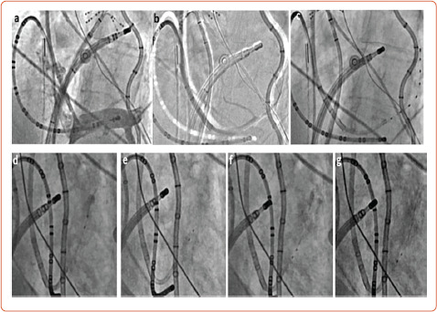 Neuromodulatory Approaches for Atrial Fibrillation Ablation.