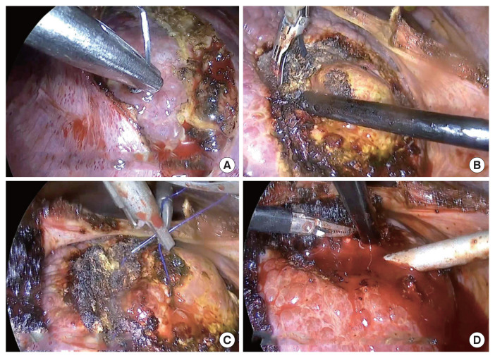 Video-assisted transthoracic liver resection in patients with marginal liver function: a retrospective cohort study.