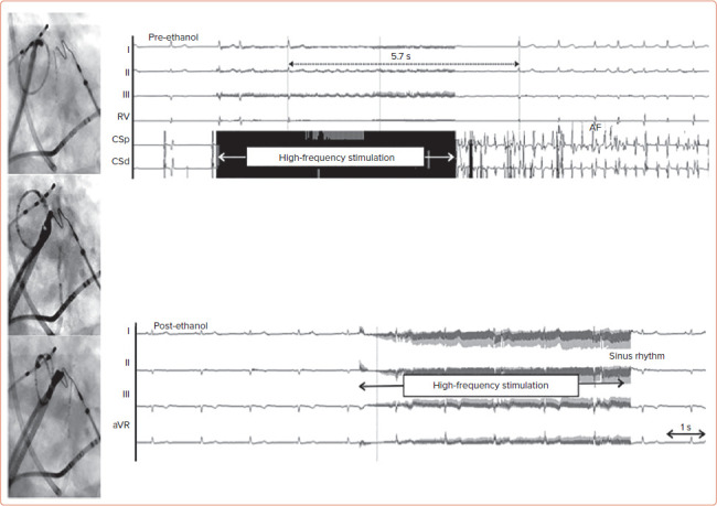 Neuromodulatory Approaches for Atrial Fibrillation Ablation.
