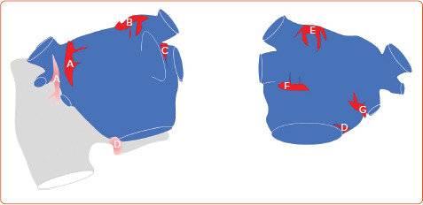 Neuromodulatory Approaches for Atrial Fibrillation Ablation.