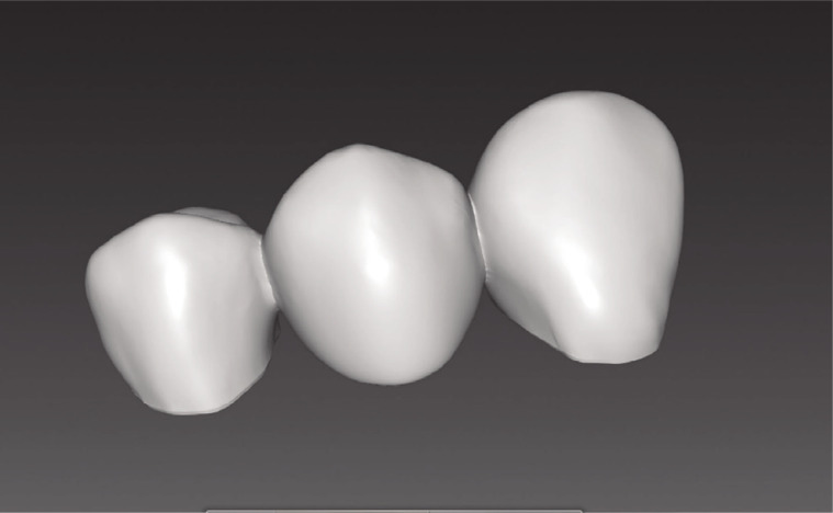 <i>In-vitro</i> evaluation of marginal and internal fit of 3-unit monolithic zirconia restorations fabricated using digital scanning technologies.