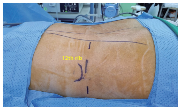 Initial experience with laparoscopic posterior retroperitoneal adrenalectomy in single tertiary center.