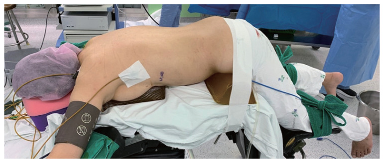 Initial experience with laparoscopic posterior retroperitoneal adrenalectomy in single tertiary center.