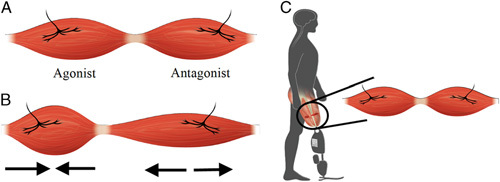 The Agonist-antagonist Myoneural Interface.