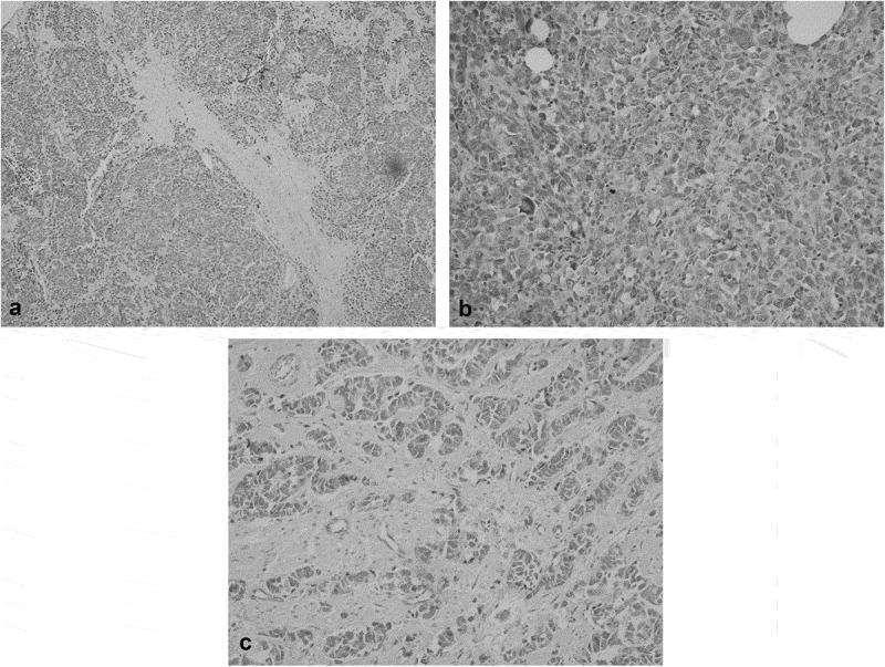 Leptin expression is substantially correlated with prognosis of urinary bladder carcinoma.