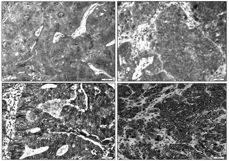 Prognostic value of E-Cadherin and its tumor suppressor role in Saudi women with advanced epithelial ovarian cancer.