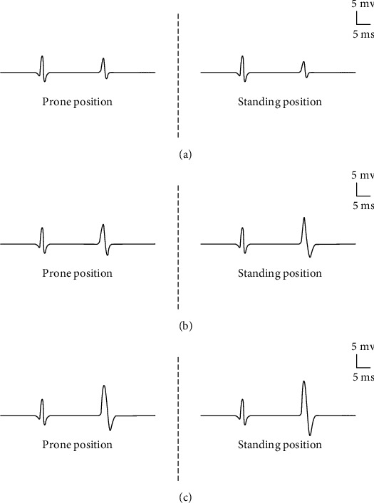 Soleus H-Reflex Change in Poststroke Spasticity: Modulation due to Body Position.