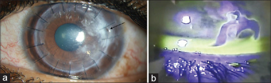 Corneal Perforation as a Complication of Fungal Interface Infectious Keratitis after Deep Anterior Lamellar Keratoplasty.