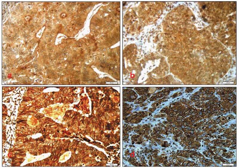 Prognostic value of E-Cadherin and its tumor suppressor role in Saudi women with advanced epithelial ovarian cancer.