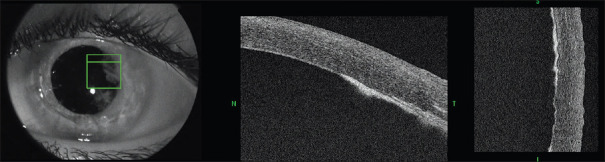 Corneal Perforation as a Complication of Fungal Interface Infectious Keratitis after Deep Anterior Lamellar Keratoplasty.