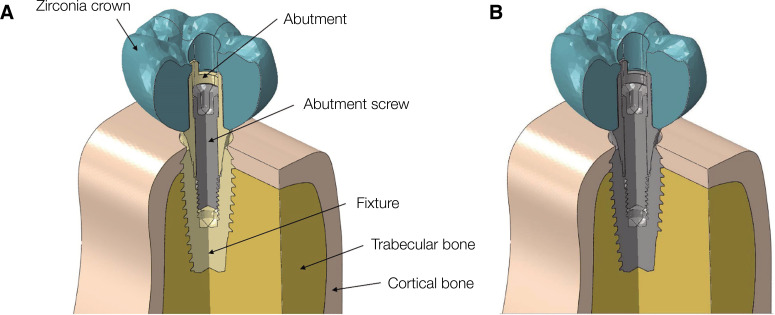 Comparative finite element analysis of mandibular posterior single zirconia and titanium implants: a 3-dimensional finite element analysis.