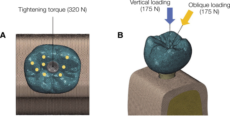 Comparative finite element analysis of mandibular posterior single zirconia and titanium implants: a 3-dimensional finite element analysis.