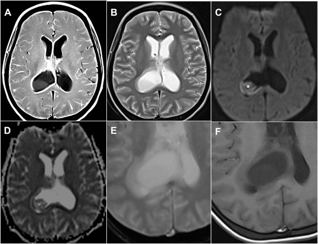 Intraventricular tuberculosis abscess in an immunocompromised patient: clinical vignette.