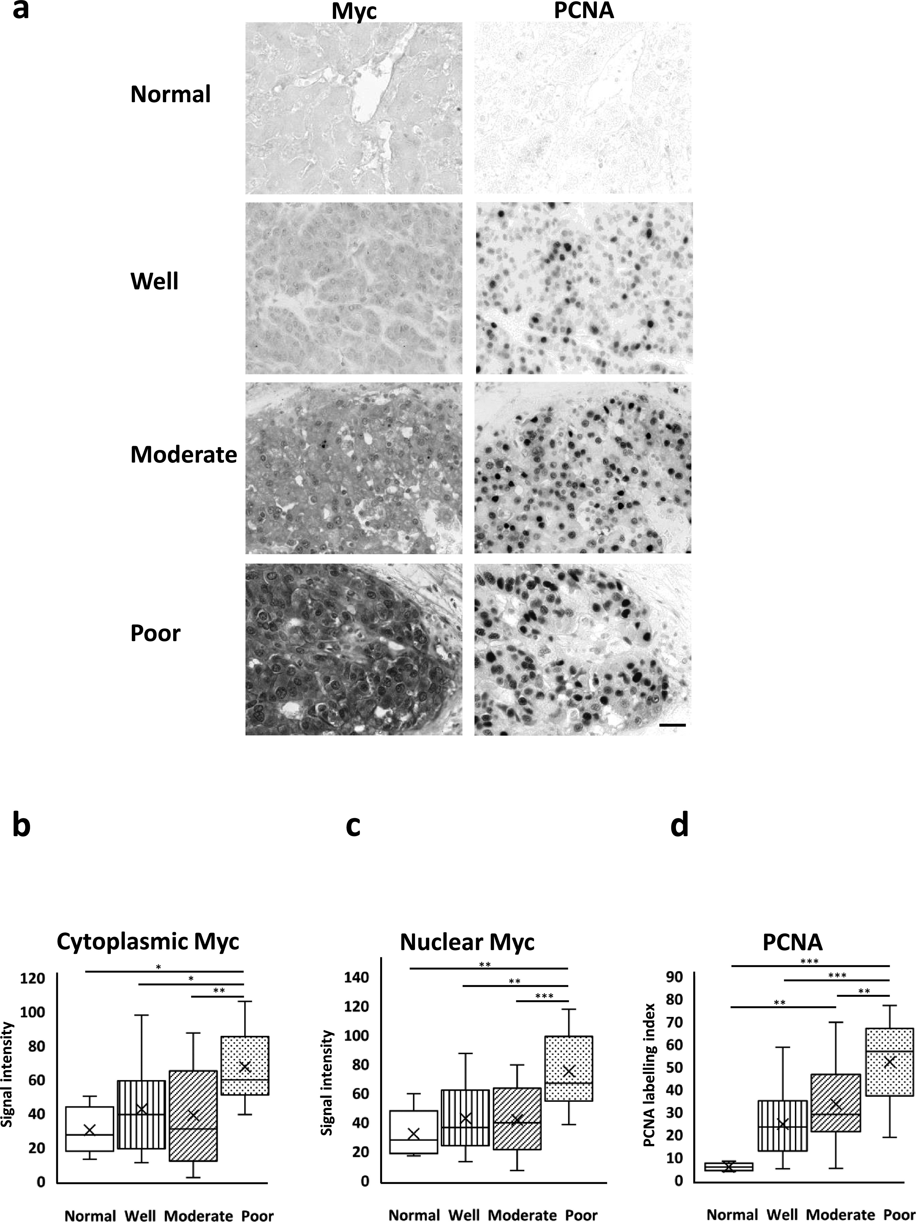 Nuclear Expression of Pygo2 Correlates with Poorly Differentiated State Involving c-Myc, PCNA and Bcl9 in Myanmar Hepatocellular Carcinoma.