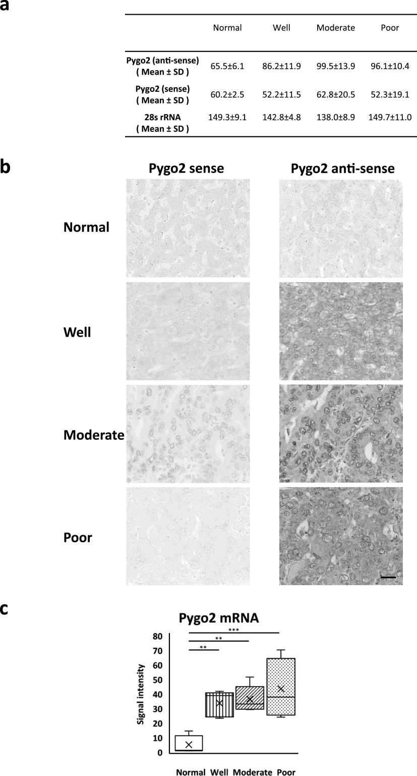 Nuclear Expression of Pygo2 Correlates with Poorly Differentiated State Involving c-Myc, PCNA and Bcl9 in Myanmar Hepatocellular Carcinoma.