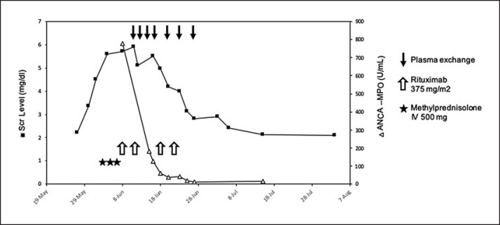 Efficacy of Plasmapheresis in Nivolumab-Associated ANCA Glomerulonephritis: A Case Report and Pathophysiology Discussion.