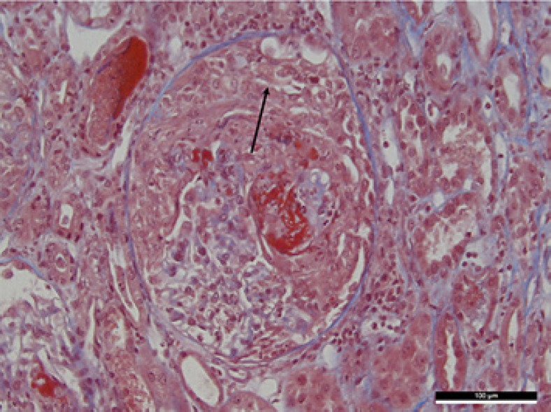 Efficacy of Plasmapheresis in Nivolumab-Associated ANCA Glomerulonephritis: A Case Report and Pathophysiology Discussion.