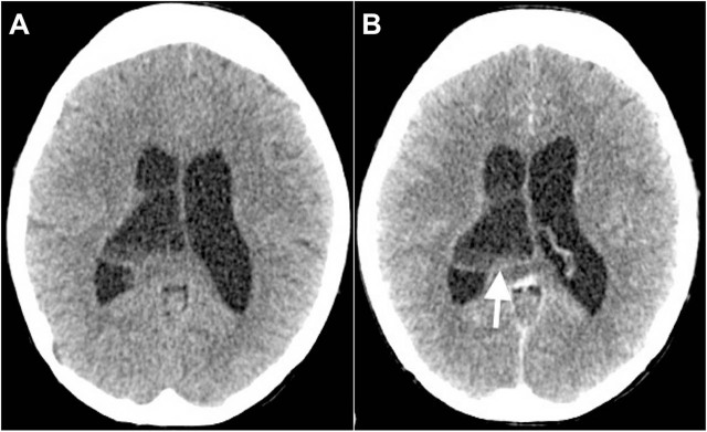 Intraventricular tuberculosis abscess in an immunocompromised patient: clinical vignette.