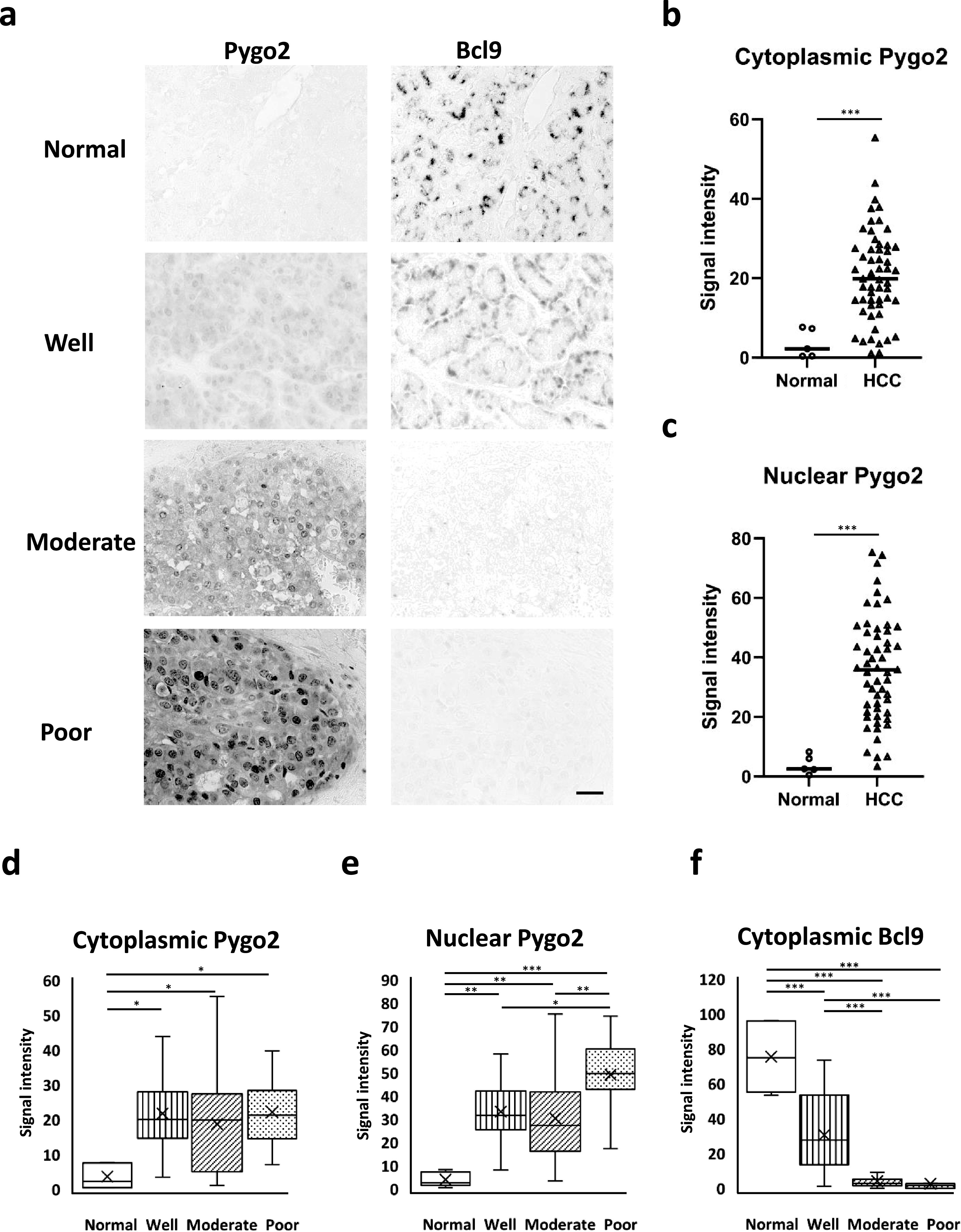 Nuclear Expression of Pygo2 Correlates with Poorly Differentiated State Involving c-Myc, PCNA and Bcl9 in Myanmar Hepatocellular Carcinoma.