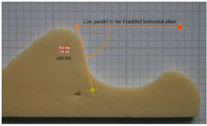 Articular Eminence Morphology of American Historic and Contemporary Populations.