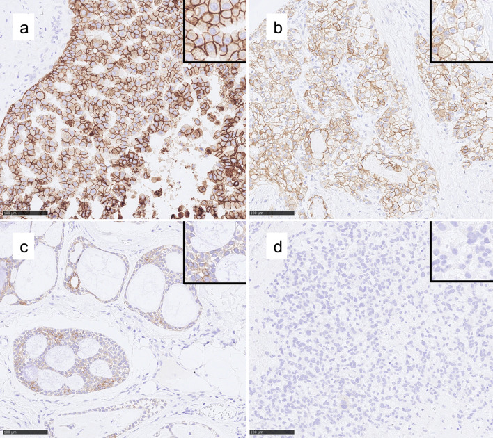 Trophoblast Cell Surface Antigen 2 (Trop-2) Protein is Highly Expressed in Salivary Gland Carcinomas and Represents a Potential Therapeutic Target.