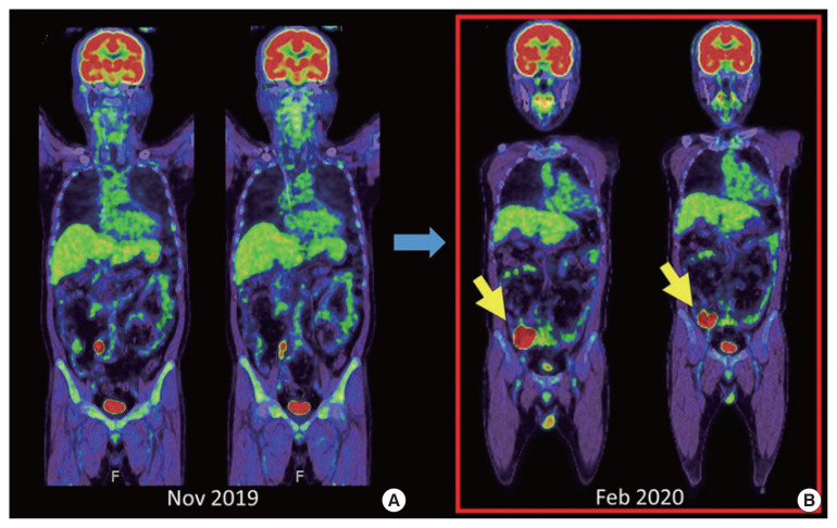 Experience of serious intestinal hemorrhage and perforation in small bowel lymphoma: a case report.