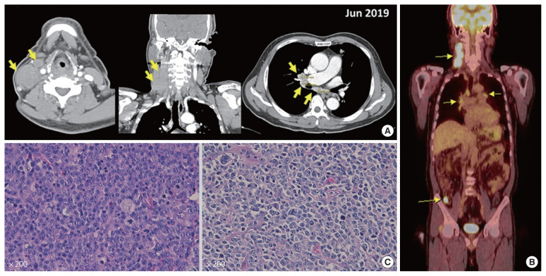 Experience of serious intestinal hemorrhage and perforation in small bowel lymphoma: a case report.