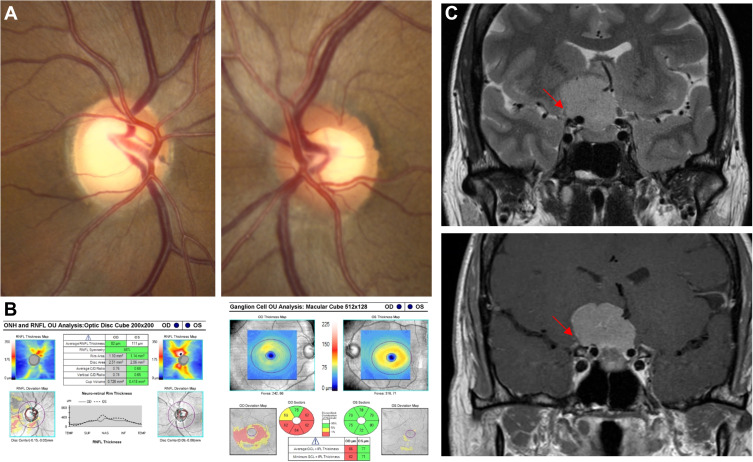 Neuro-Ophthalmological Optic Nerve Cupping: An Overview.