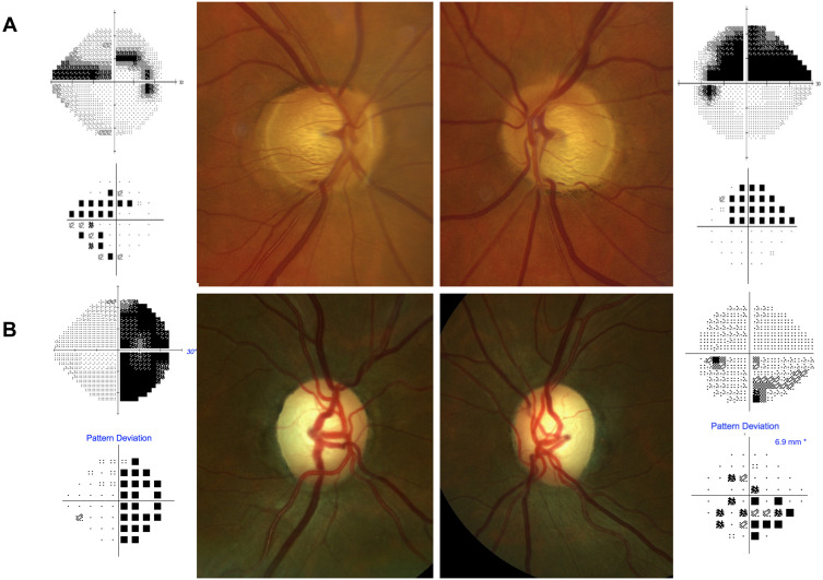 Neuro-Ophthalmological Optic Nerve Cupping: An Overview.