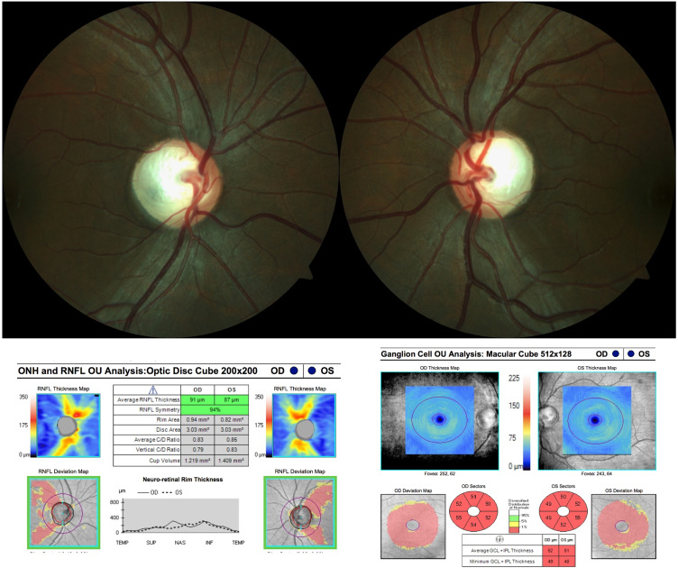 Neuro-Ophthalmological Optic Nerve Cupping: An Overview.