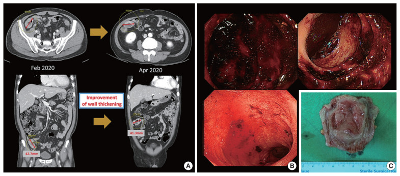 Experience of serious intestinal hemorrhage and perforation in small bowel lymphoma: a case report.