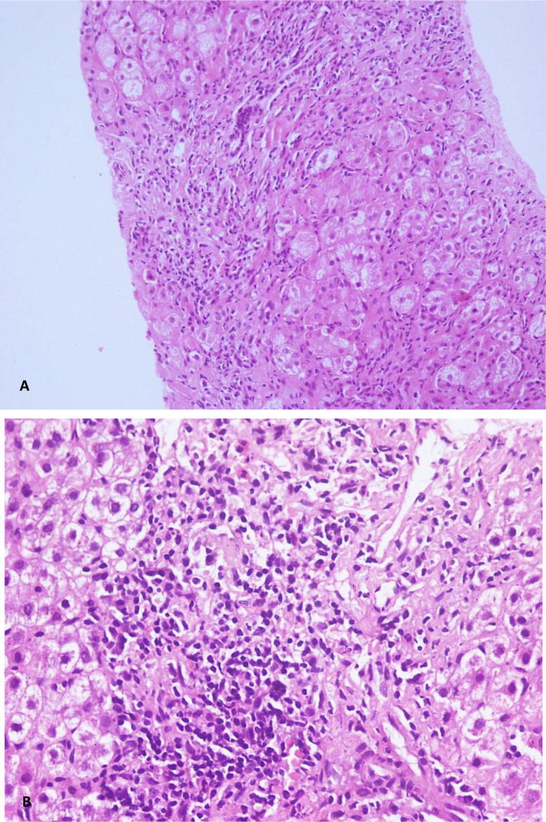 A rare etiology of persistent jaundice in type 1 autoimmune hepatitis.