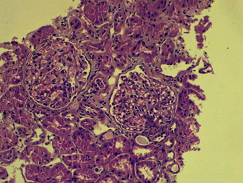 An Interesting Case of Nonlupus Full-House Nephropathy.