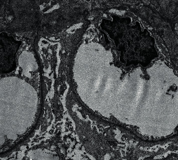 An Interesting Case of Nonlupus Full-House Nephropathy.