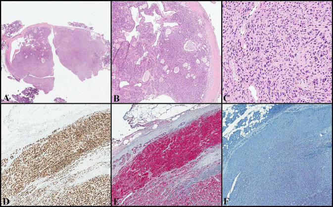 Co-expression of Myoepithelial and Melanocytic Features in Carcinoma Ex Pleomorphic Adenoma.