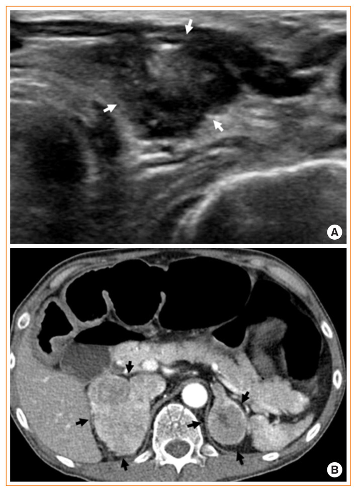 Mucosal Neuroma Cues for Endocrine Emergency Treatment.