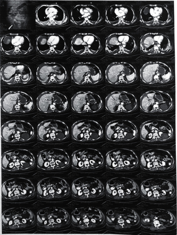 A Rare Case of Pseudomembranous Colitis Presenting with Pleural Effusion and Ascites with Literature Review.