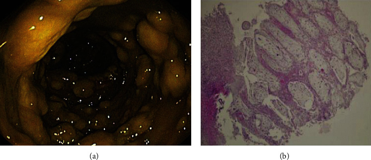 A Rare Case of Pseudomembranous Colitis Presenting with Pleural Effusion and Ascites with Literature Review.