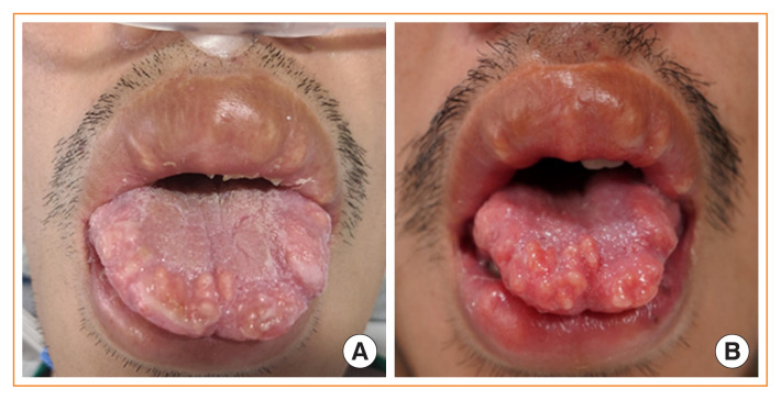 Mucosal Neuroma Cues for Endocrine Emergency Treatment.