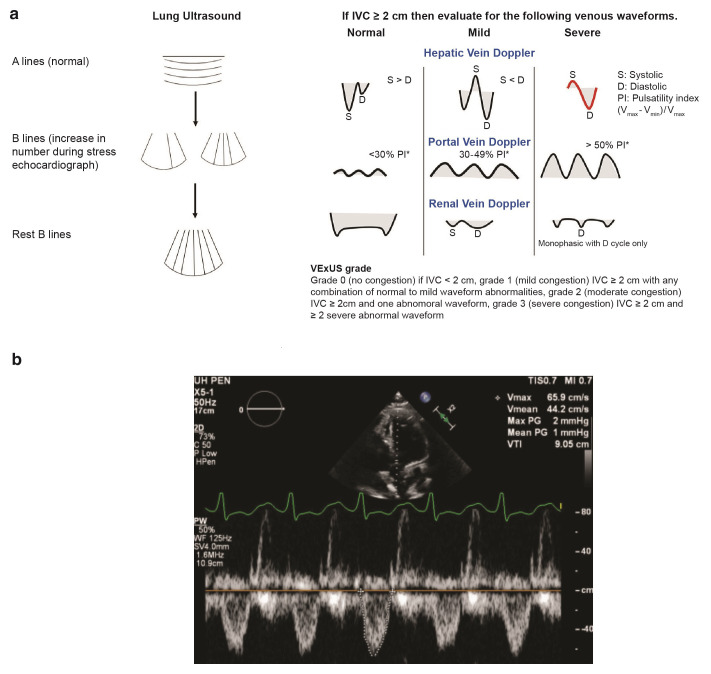 Medical management of acute heart failure.