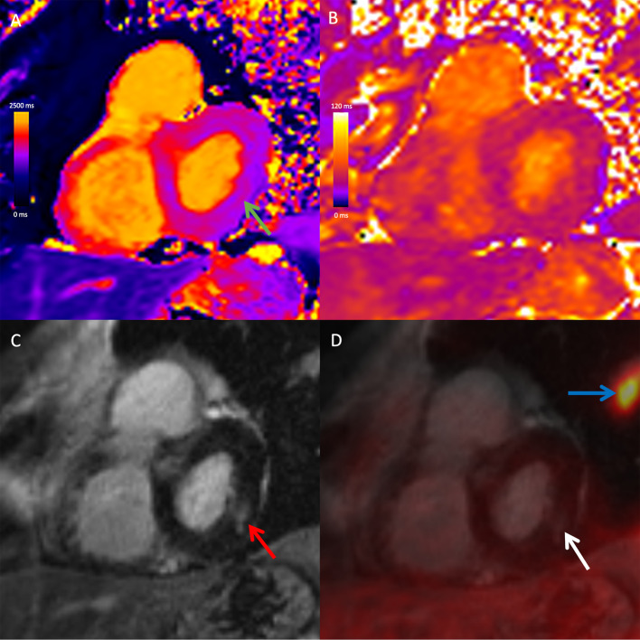 Combined simultaneous FDG-PET/MRI with T1 and T2 mapping as an imaging biomarker for the diagnosis and prognosis of suspected cardiac sarcoidosis.