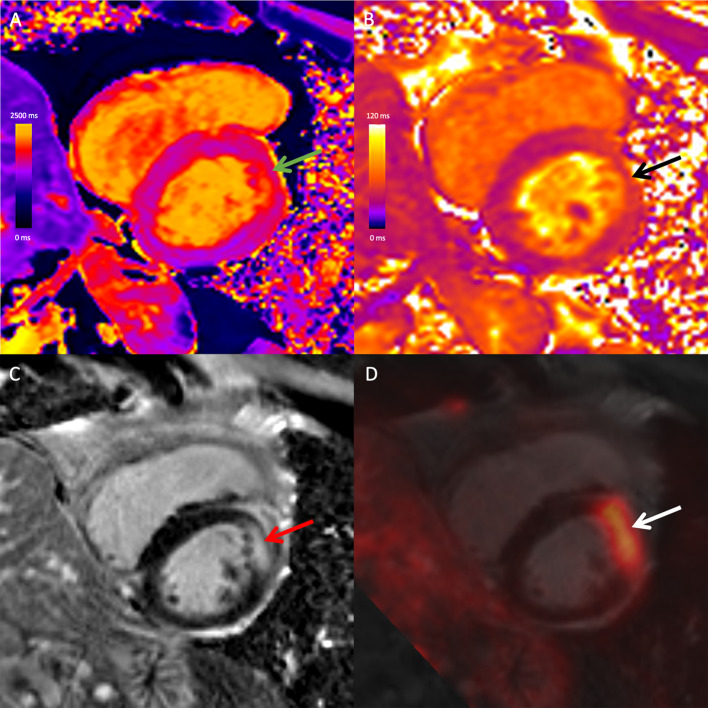 Combined simultaneous FDG-PET/MRI with T1 and T2 mapping as an imaging biomarker for the diagnosis and prognosis of suspected cardiac sarcoidosis.