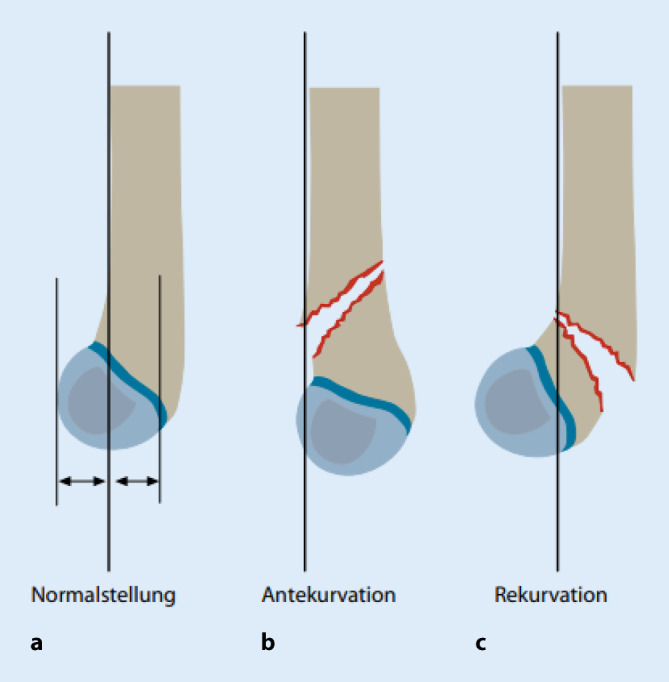 [7/m-Fall from a tree : Preparation for the medical specialist examination: part 78].