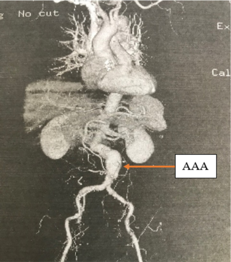 Endovascular repair of symptomatic abdominal aortic aneurysm: a seminal case in West Africa.